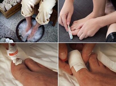 蒸脚并在受真菌感染的指甲上涂抹尿素霜