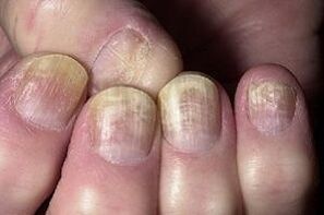 指甲被真菌感染改变
