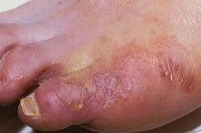 腿部皮肤真菌感染的表现