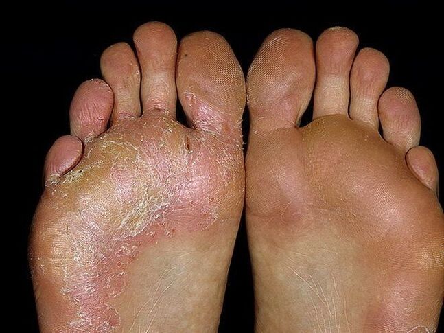 脚上真菌的症状