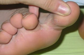 真菌之间的脚趾