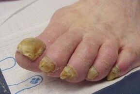 脚趾甲真菌症状