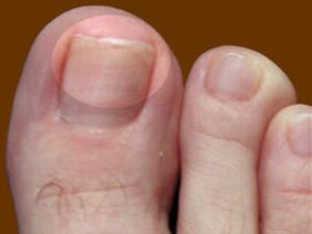 脚趾甲真菌 - 使用杀菌滴剂的指示