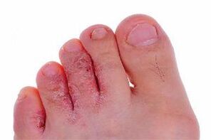 脚趾真菌症状