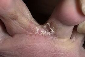 脚趾间的皮肤真菌