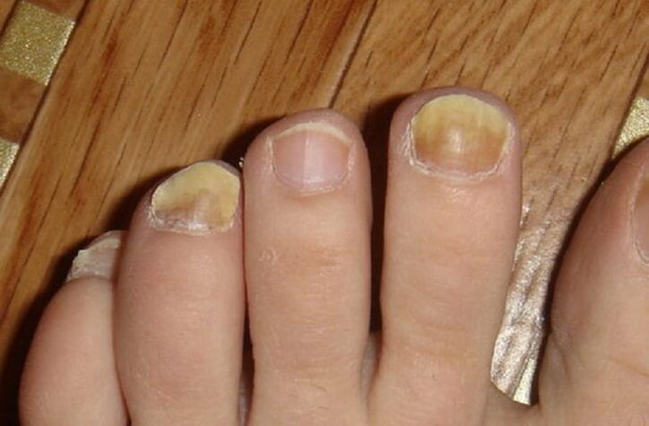 指甲和脚部皮肤上的真菌症状