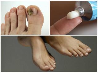 真菌的脚趾甲的治疗
