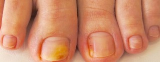 真菌的脚趾甲的症状
