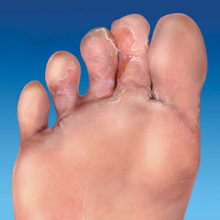 皮肤真菌脚