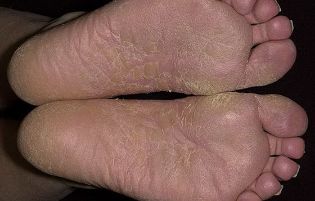 菌类的脚